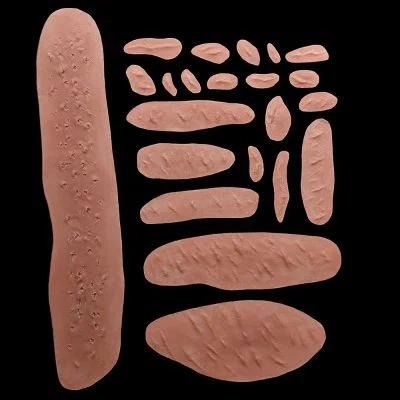 WD1 - Set of Keloid Scars