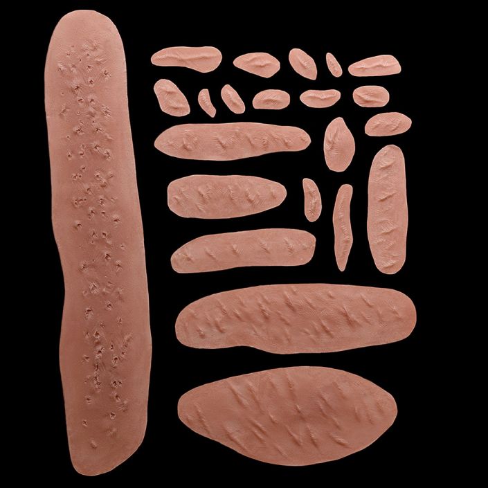 WD1 - Set of Keloid Scars